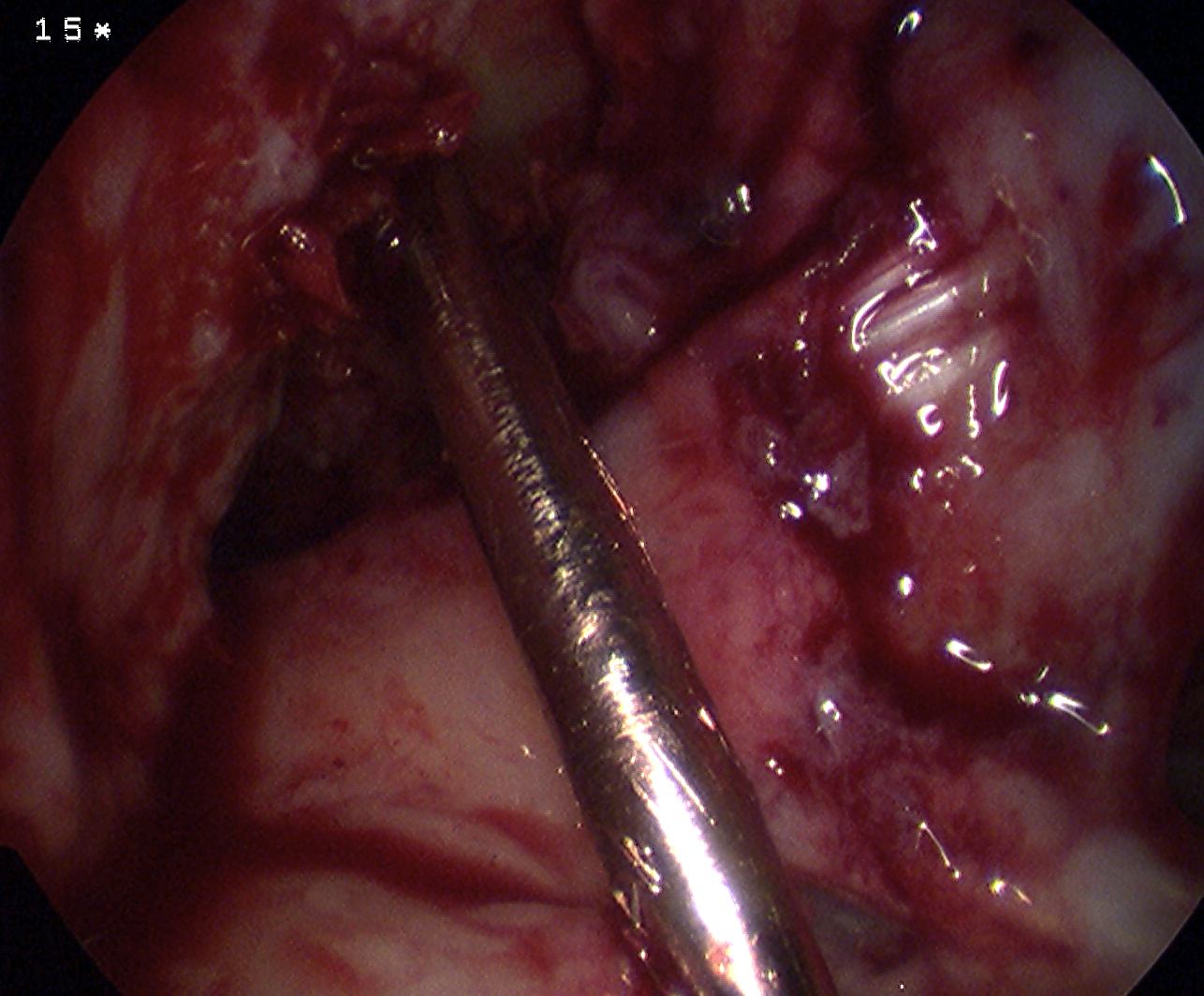 ACL Transtibial Beath Pin 2